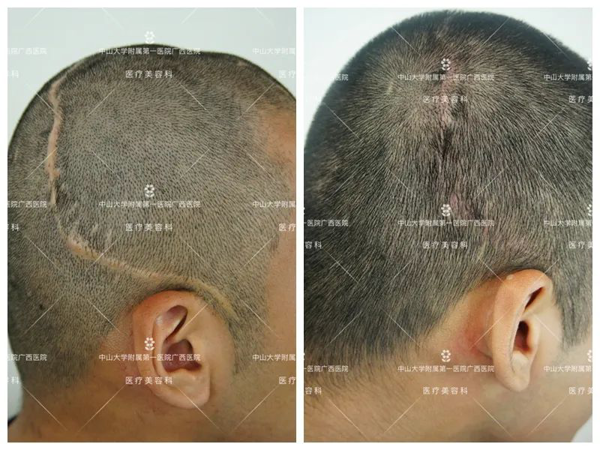 头上的疤痕可以用植发补救吗？中山一院广西医院自体毛发移植术助患者解决“头等大事”
