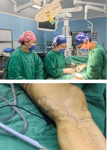 静脉曲张怕开刀？普通外科微波消融术助患者告别“蚯蚓腿”