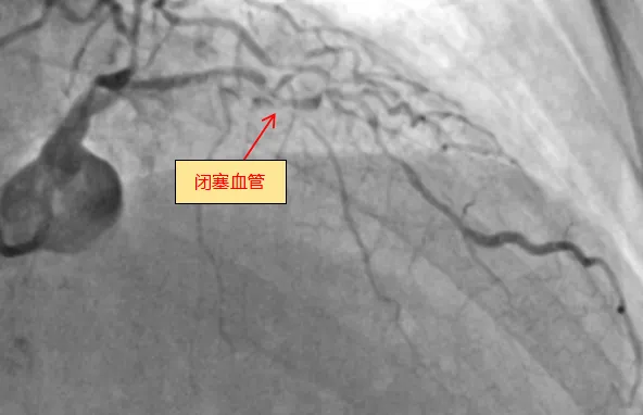 中山一院广西医院完成全新ROTAPRO™旋磨介入治疗系统上市后广西首例应用