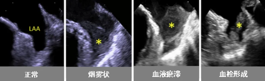 心脏彩超还能从食道里做？中山一院广西医院超声医学科“贴心侦探”助你一臂之力