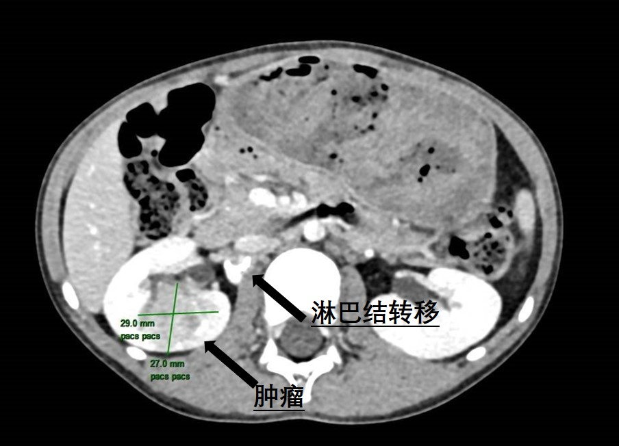 6岁患儿肾脏暗藏罕见肿瘤 | 中山一院广西医院泌尿外科精准手术“摘瘤”