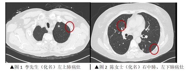 中山一院广西医院为一对“夫妻肺癌”患者进行同期微创手术治疗