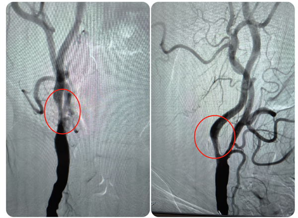 中山一院广西医院成功救治高龄高危颈动脉狭窄患者